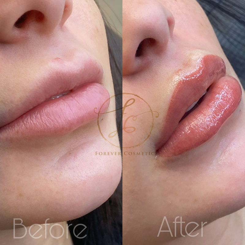 LIP TATTOOING – Skincare Laser Clinic